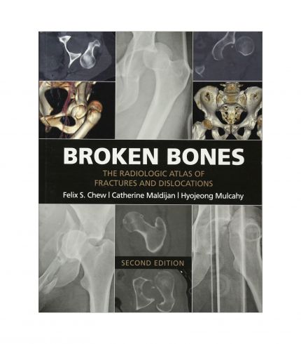 Broken Bones by Felix Chew